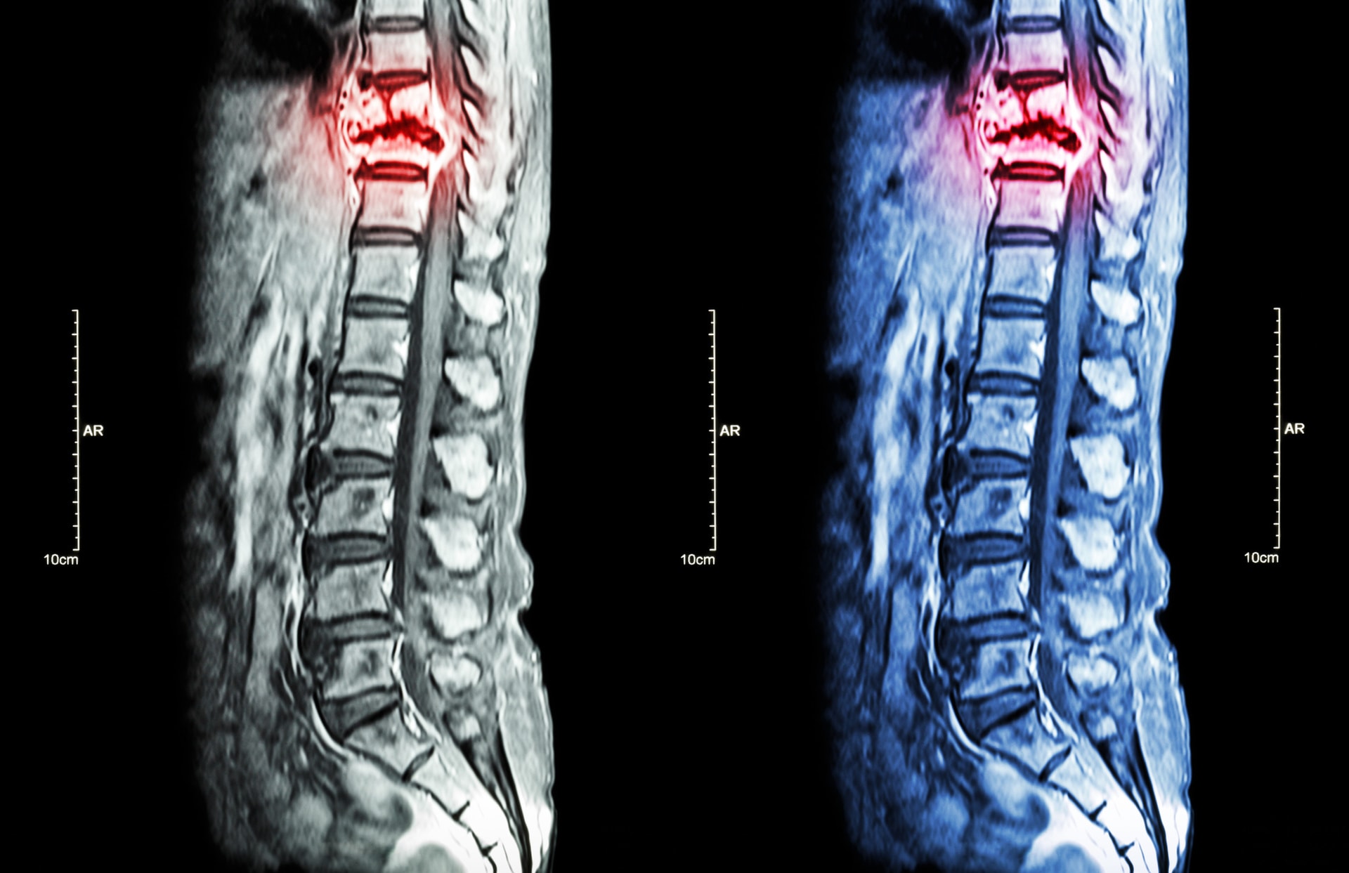 types of minimally invasive spine surgery